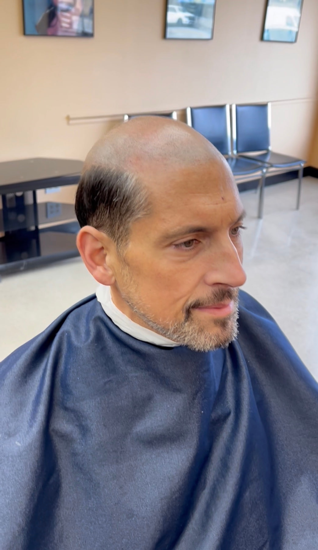 UMH client before his custom dark hair system was fitted