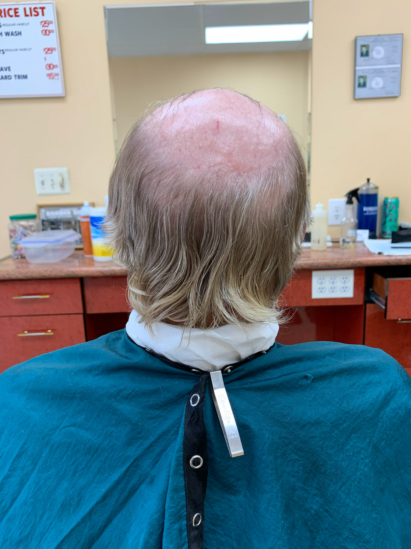 Older UMH client before receiving his custom gray hair system